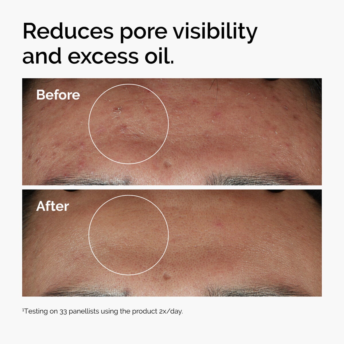 niacinamide-10-zinc-1-g9 ord-niacinamide-zinc-blemish-serum-before-after-pores.jpg