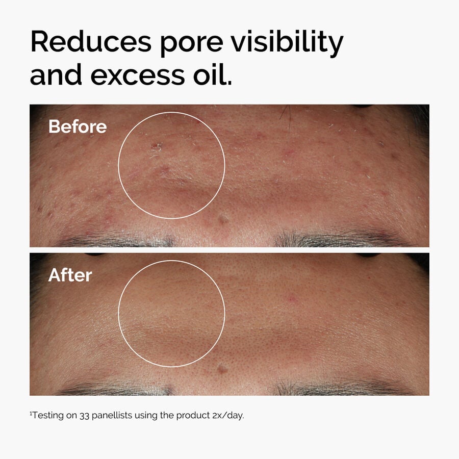 niacinamide-10-zinc-1-g9 ord-niacinamide-zinc-blemish-serum-before-after-pores.jpg