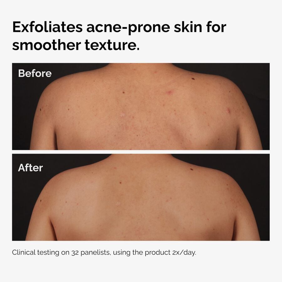 the-body-care-collection-x2 ord-salicylic-acid-body-serum-before-after-graphic-NA.jpg