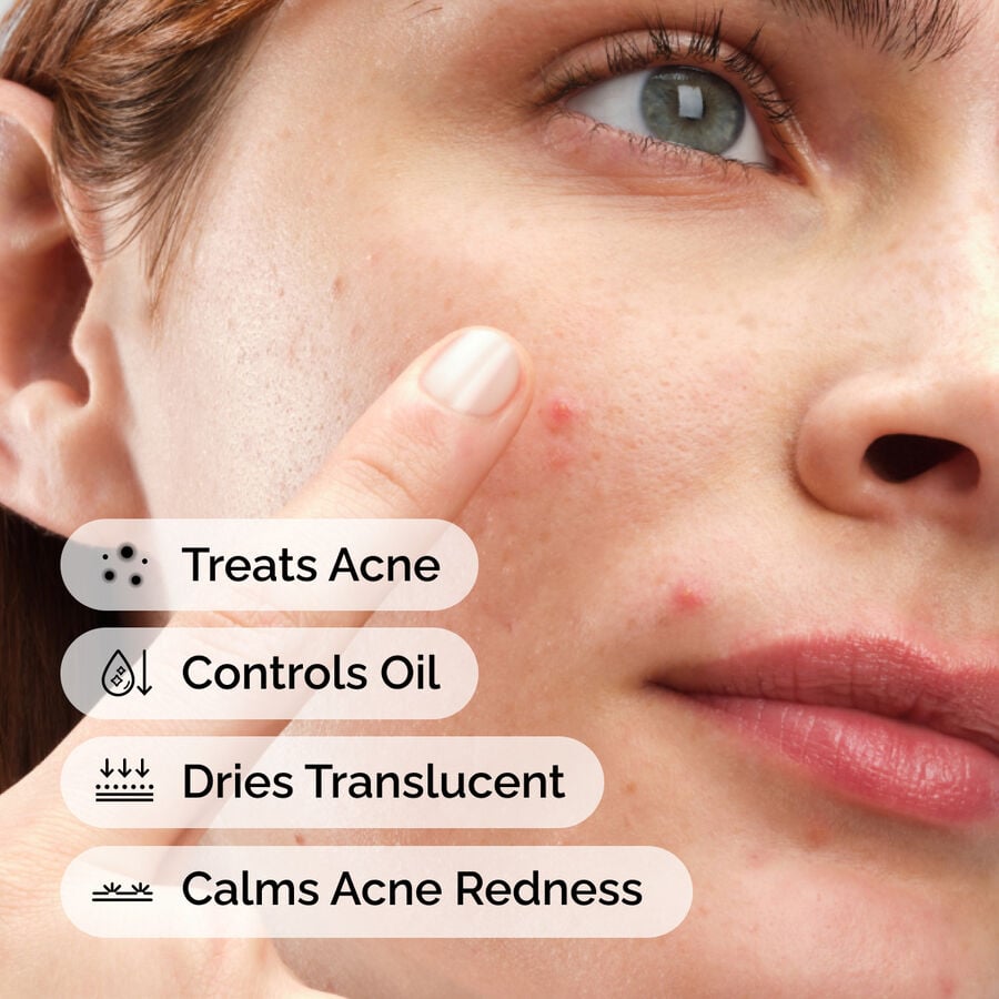 sulfur-10-powder-to-cream-concentrate-w5 ord-sulfur-10pct-powder-to-cream-concentrate-model-application-with-benefits-acne.jpg
