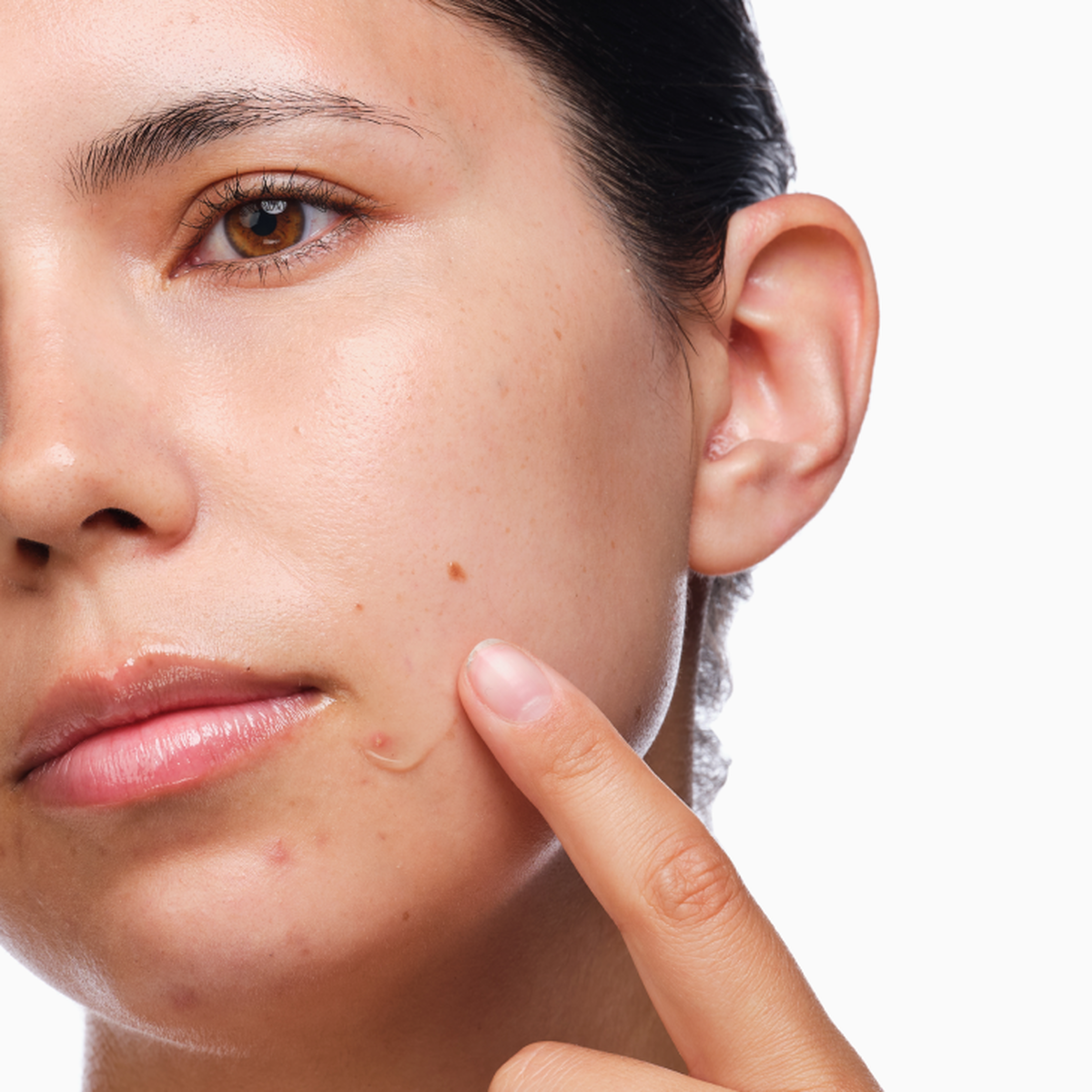 the-acne-set-h3 rdn-the-acne-set-application.png